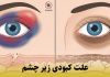 علت کبودی زیر چشم