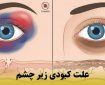 راهنمای جامع علت کبودی زیر چشم: از ضربه فیزیکی تا تیرگی‌های مزمن پوستی