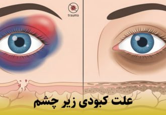راهنمای جامع علت کبودی زیر چشم: از ضربه فیزیکی تا تیرگی‌های مزمن پوستی