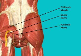 رهایی از درد مزمن کف لگن؛ داستان واقعی بهبود از نورالژی پودندال