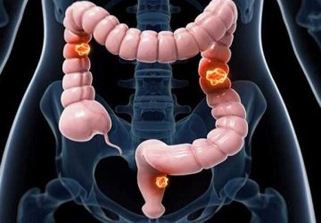 عوامل ابتلا به سرطان روده بزرگ را بشناسیم