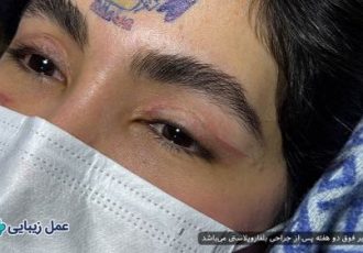 بهترین عملهای زیبایی با دوره نقاهت کوتاه برای انجام قبل از عید بهترین عملهای زیبایی با دوره نقاهت کوتاه برای انجام قبل از عید