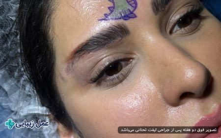 لیفت تحتانی ابرو