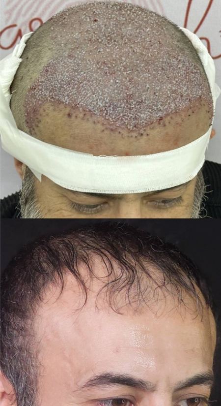 طبیعی بودن خط رویش مو در کاشت مو