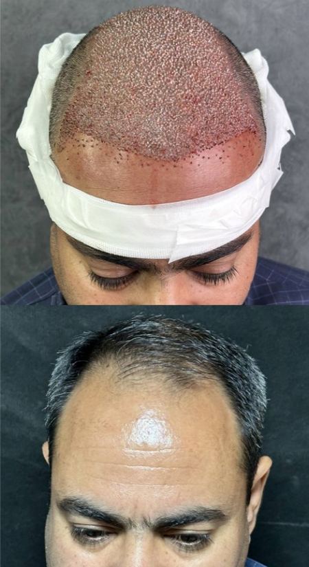 کاشت مو طبیعی