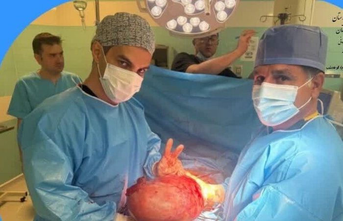 خارج‌سازی توده ۷ کیلویی تخمدان از شکم بیمار ۴۷ ساله