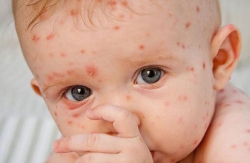 شیوع «آبله مرغان» در بهار