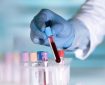 تاثیر آزمایش خون مبتنی بر DNA بر درمان سرطان گلو
