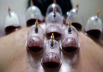 حجامت توسط افراد غیر متخصص خطرناک است