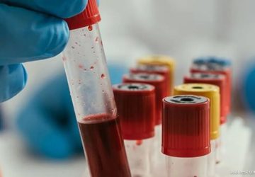 پیش بینی خطر عود سرطان خون با آزمایش ژنتیک