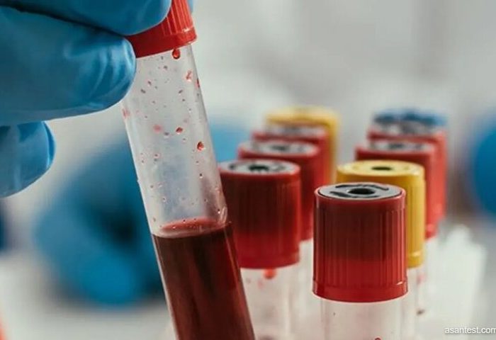 پیش بینی خطر عود سرطان خون با آزمایش ژنتیک