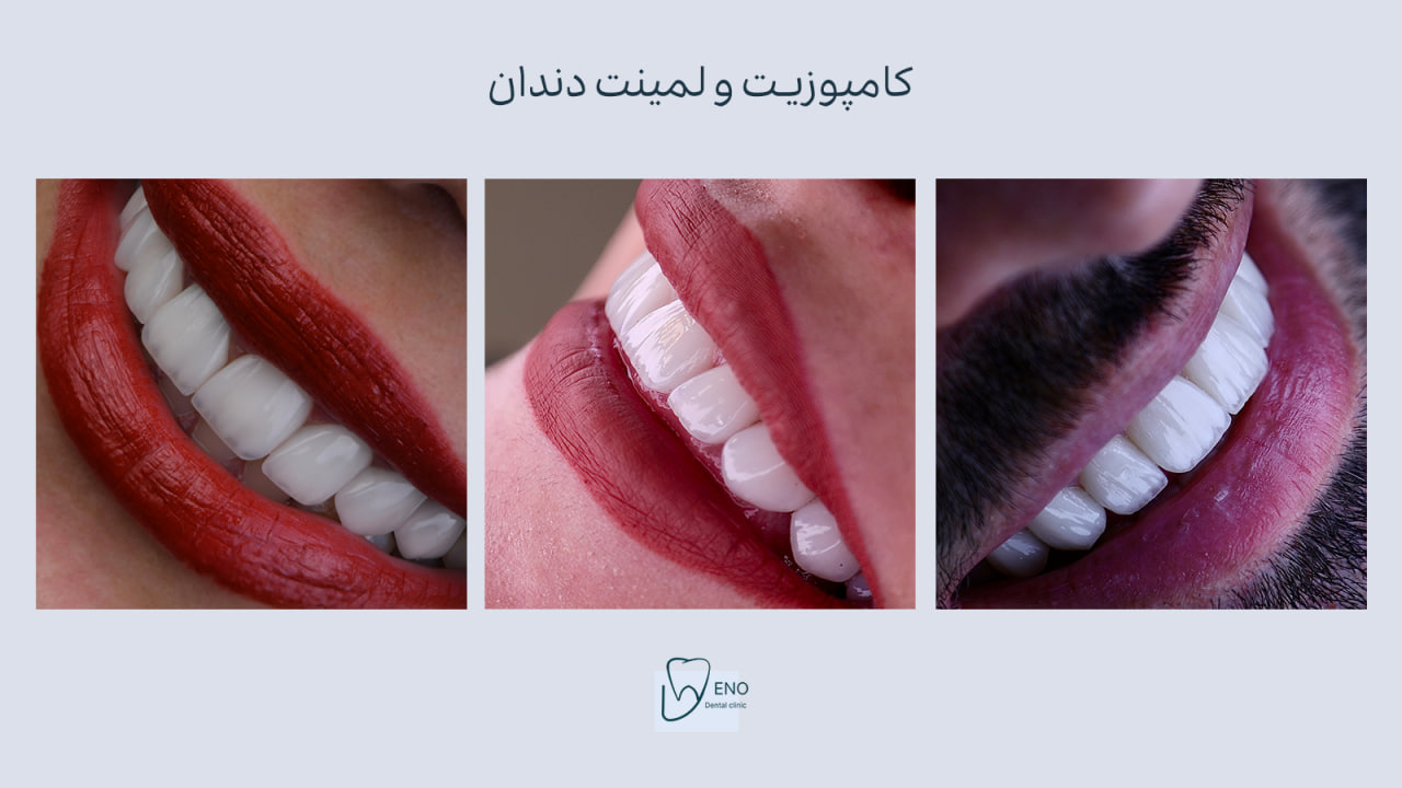 لمینت دندان