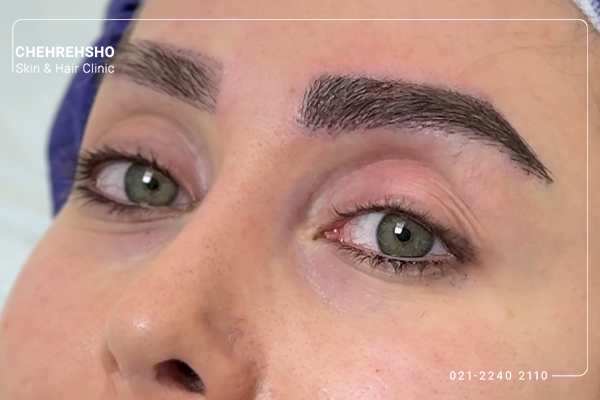 نمونه واقعی کاشت ابرو چهره شو