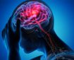 تحریک نخاع به بازیابی قدرت بازو پس از سکته مغزی کمک می کند
