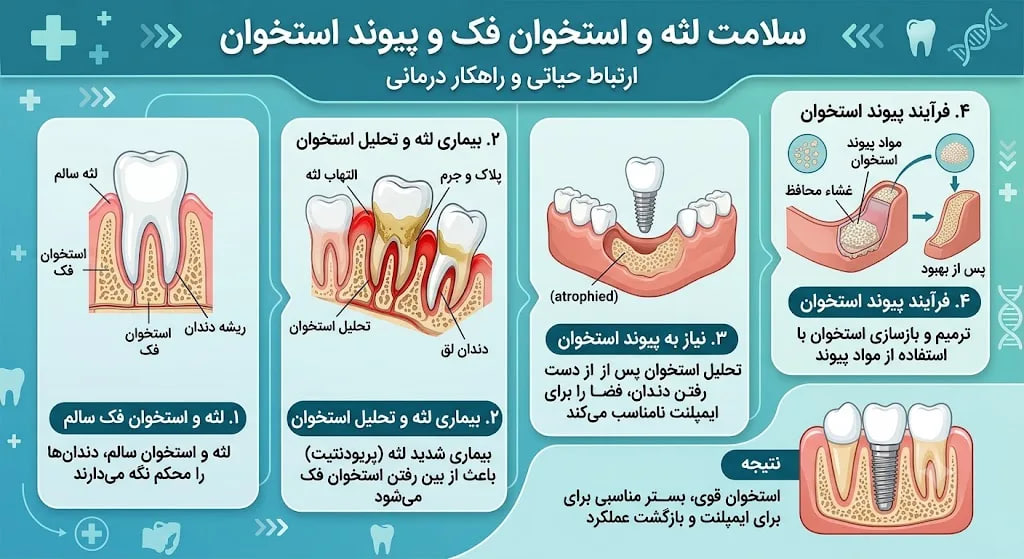 سلامت لثه قبل از ایمپلنت دندان
