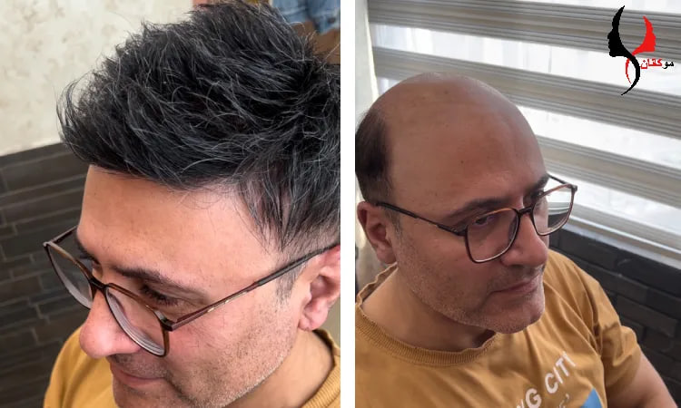 پروتز مو مردانه پروتز مو مردانه موکانان