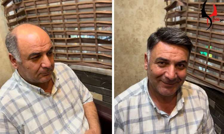 پروتز مو مردانه
