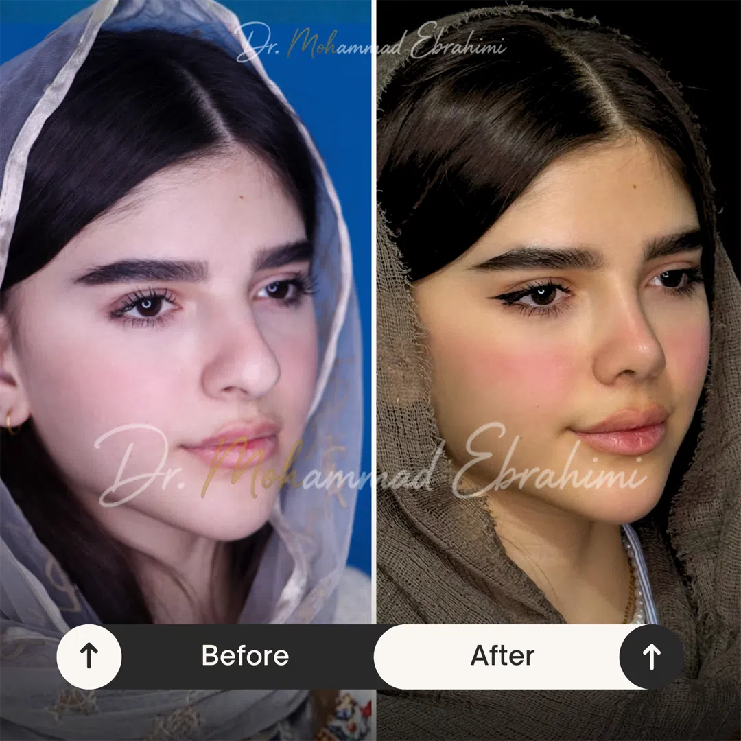 تفاوت عمل بینی طبیعی و نیمه فانتزی دقیقا در چیست؟ قبل و بعد عمل بینی طبیعی