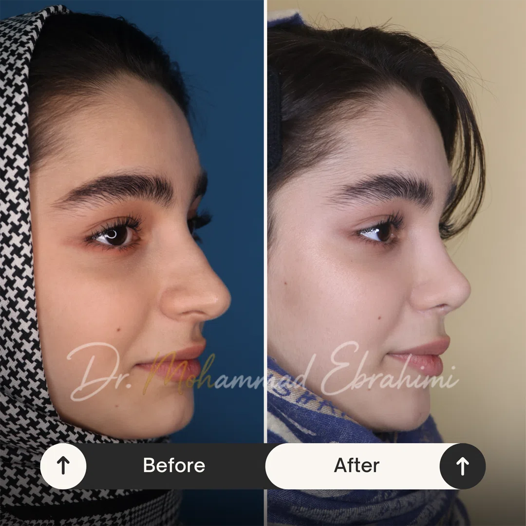 تفاوت عمل بینی طبیعی و نیمه فانتزی دقیقا در چیست؟ نمونه عمل بینی طبیعی مدرن