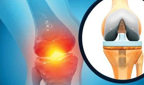 چرا تعداد متقاضیان تعویض مفصل زانو رو به افزایش است؟ چرا تعداد متقاضیان تعویض مفصل زانو رو به افزایش است؟
