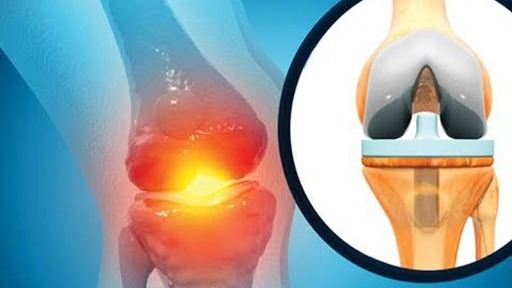 چرا تعداد متقاضیان تعویض مفصل زانو رو به افزایش است؟