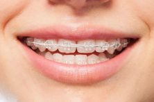 قیمت ارتودنسی - ثابت، متحرک، سرامیک قیمت ارتودنسی – ثابت، متحرک، سرامیک