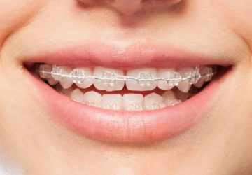 قیمت ارتودنسی – ثابت، متحرک، سرامیک