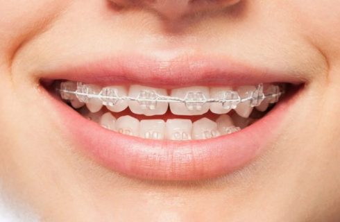 قیمت ارتودنسی - ثابت، متحرک، سرامیک قیمت ارتودنسی – ثابت، متحرک، سرامیک