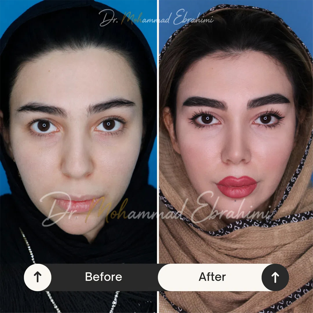 تفاوت عمل بینی طبیعی و نیمه فانتزی دقیقا در چیست؟ عمل بینی نیمه فانتزی