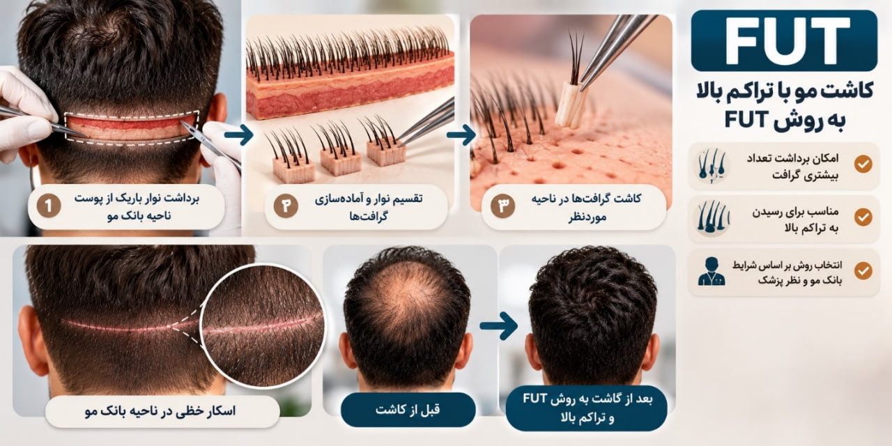 کاشت مو با تراکم بالا به روش FUT