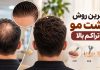 بهترین روش کاشت مو با تراکم بالا چیست؟